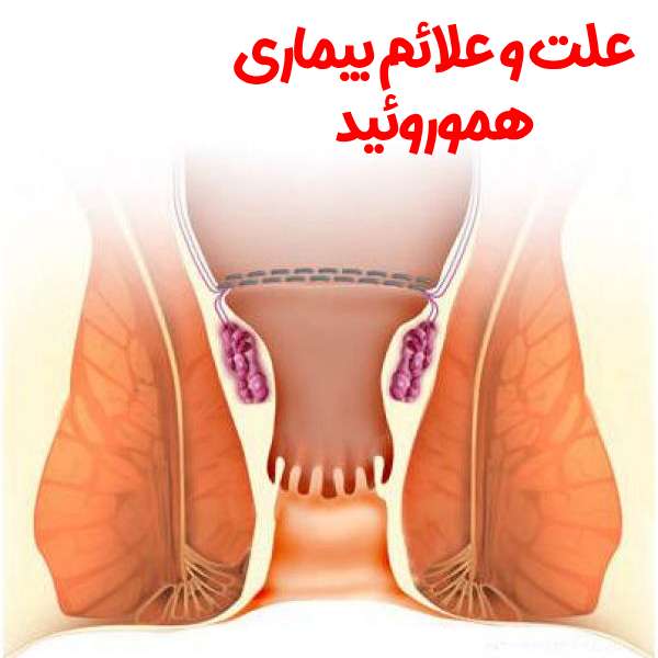 هموروئید یا بواسیر چه علائمی دارد؟