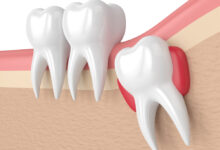 تعبیر خواب دندان عقل 🦷 (کامل و رایگان | از نظر معبران و موضوعات مختلف)