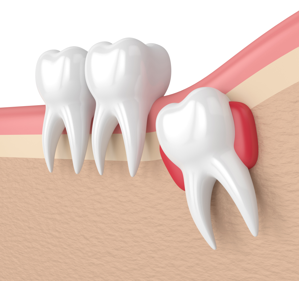 تعبیر خواب دندان عقل 🦷 (کامل و رایگان | از نظر معبران و موضوعات مختلف) تعبیر خواب دندان عقل 🦷 (کامل و رایگان | از نظر معبران و موضوعات مختلف)