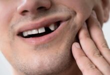 تعبیر خواب شکستن دندان 🦷 (کامل و رایگان | از نظر معبران و موضوعات مختلف)