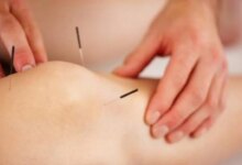 بهترین متخصص طب سوزنی در شیراز + آدرس و تلفن