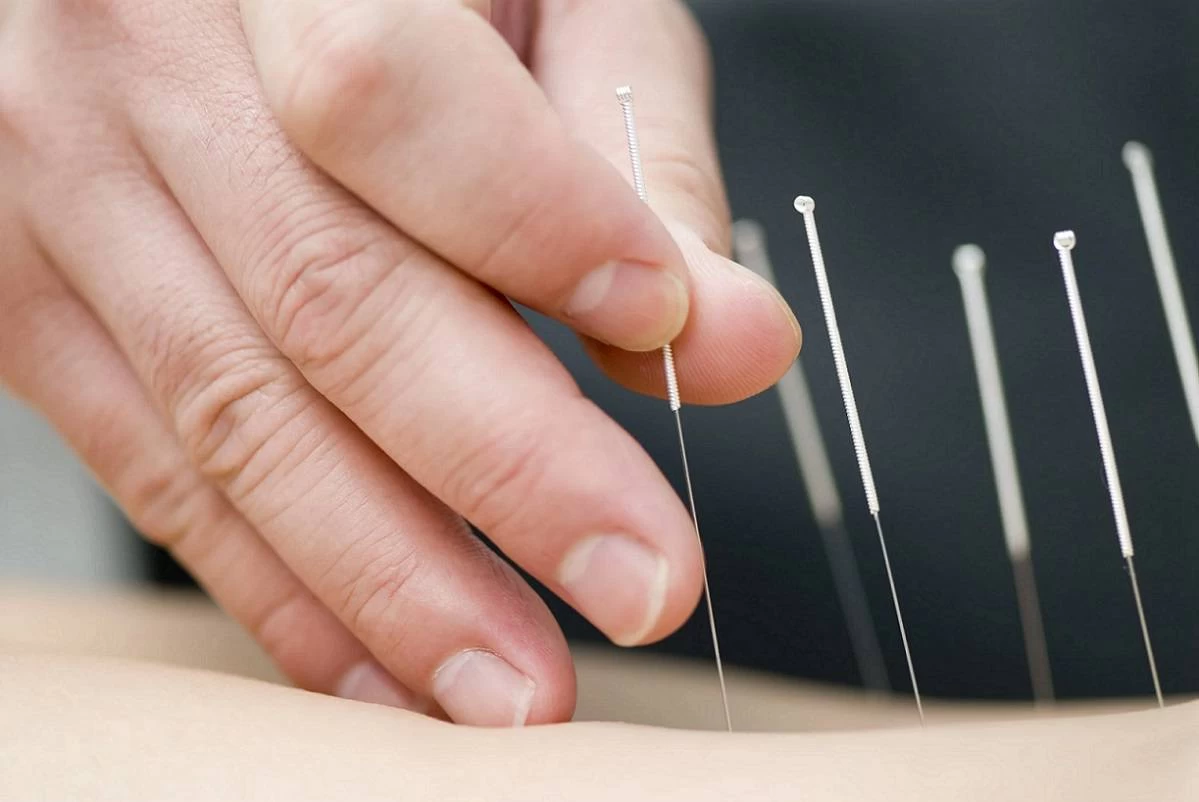 بهترین متخصص طب سوزنی در کرمان + آدرس و تلفن بهترین متخصص طب سوزنی در کرمان + آدرس و تلفن
