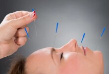 بهترین متخصص طب سوزنی در کرمانشاه + آدرس و تلفن