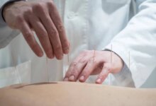 لیست بهترین متخصص طب سوزنی در تهران + آدرس و تلفن