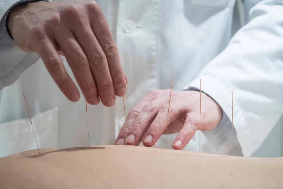 لیست بهترین متخصص طب سوزنی در تهران + آدرس و تلفن