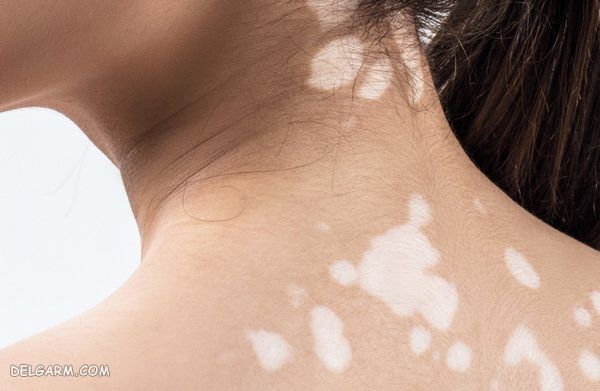 رژیم غذایی مناسب برای بیماری پیسی یا ویتیلیگو