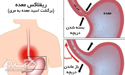 رفلاکس معده