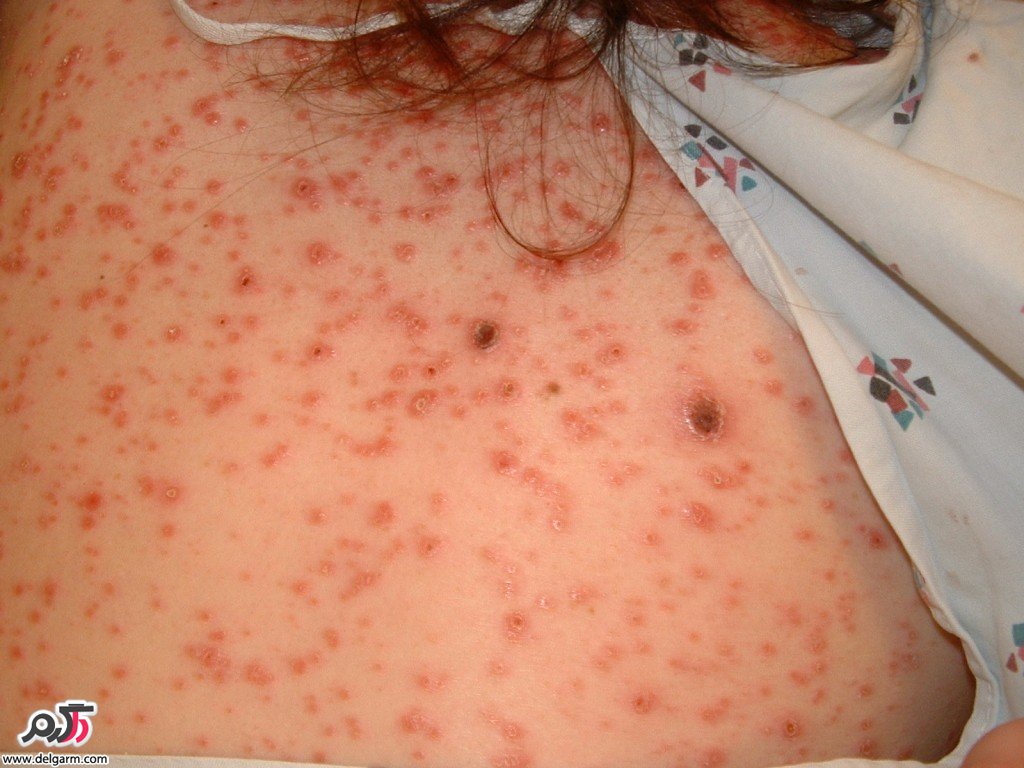 تشخیص و درمان بیماری سیفلیس( سفلیس ( Syphilis)) (2 نکته مهم)