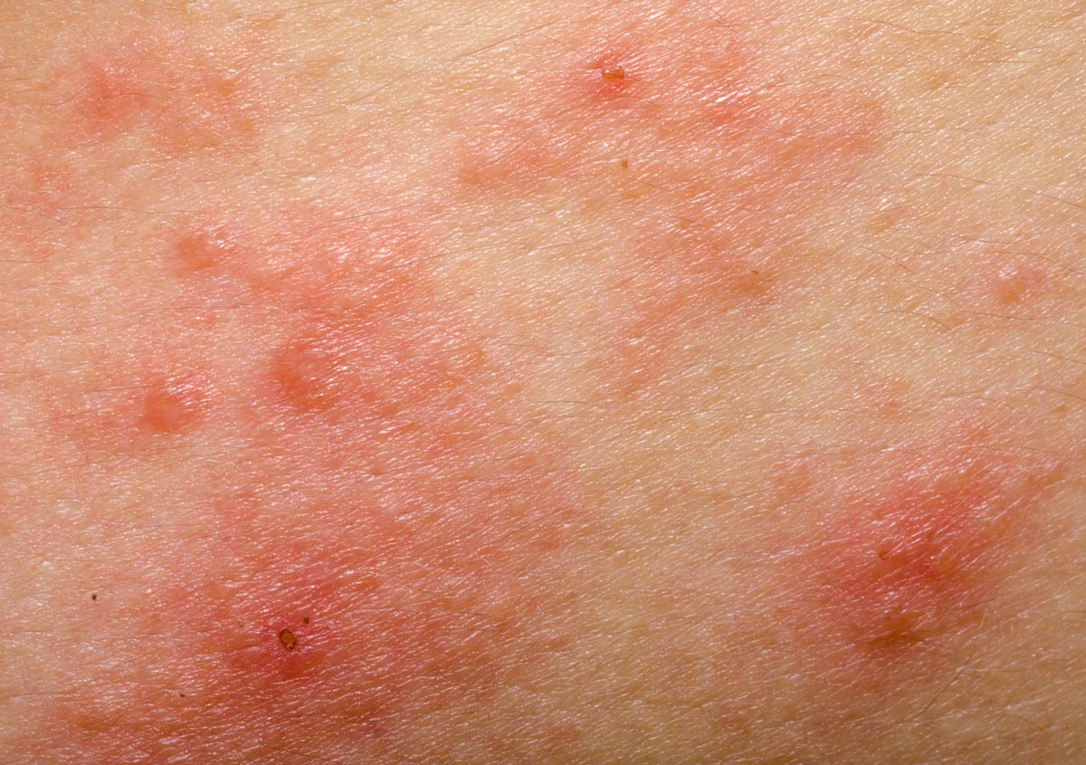 گزش ساس در برابر گزش کک