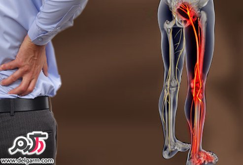 علت ایجاد ساتیک؛پیشگیری و درمان سیاتیک پا و کمر (2 نکته مهم)