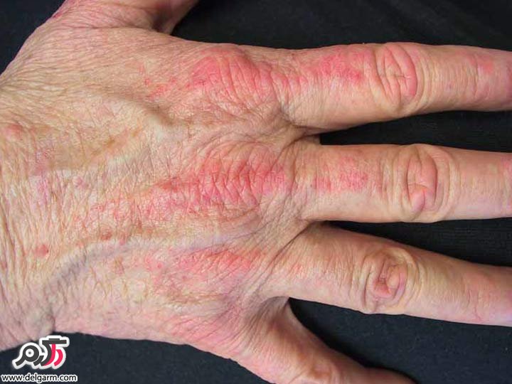 همه چیز در مورد درماتومیوزیت (Dermatomyositis) (2 نکته مهم)