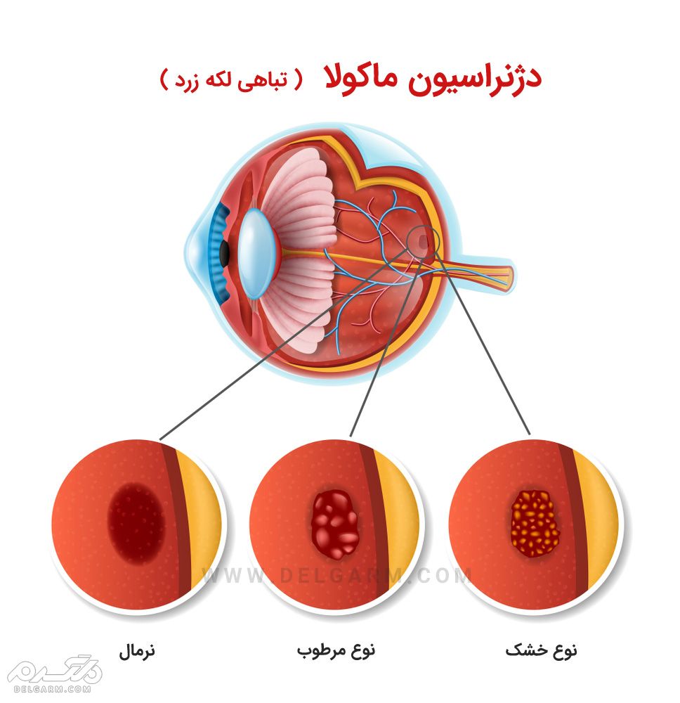 دژنراسیون ماکولا Macular degeneration AMD تباهی لکه زرد
