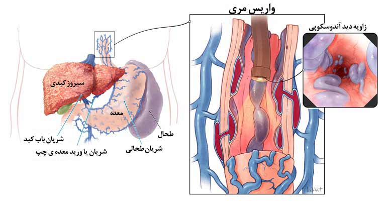 واریس مری چیست؟ + بهترین راه درمان واریس مری (2 نکته مهم)