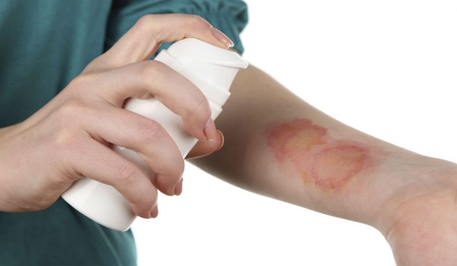 چگونه درد و سوزش ناشی از سوختگی را کاهش دهیم؟ (2 نکته مهم)