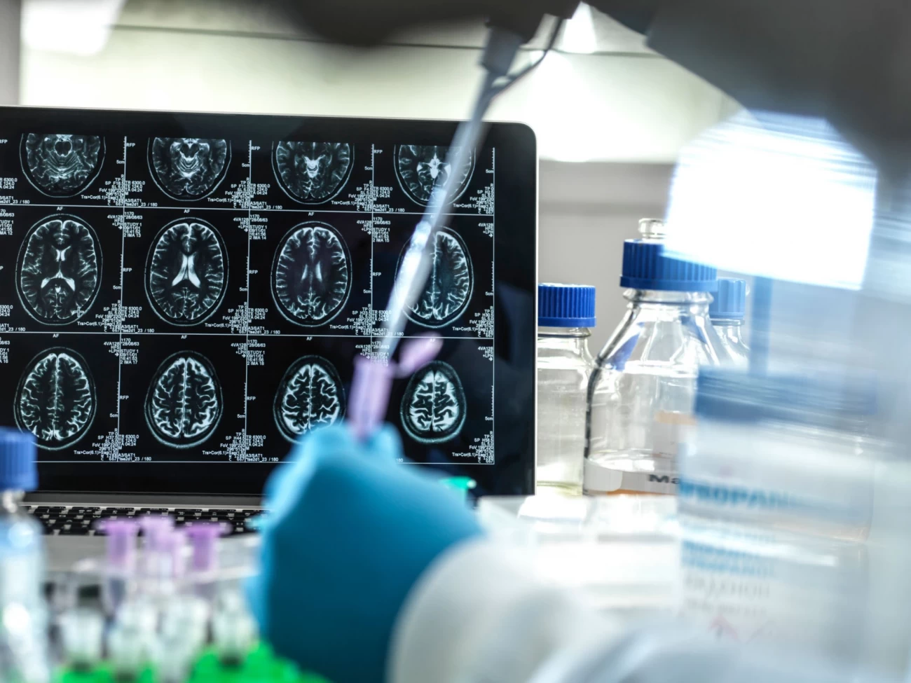 Alzheimer's disease
