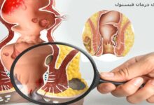 لیزر فیستول مقعد بهترین روش سرپایی درمان فیستول (2 نکته مهم)