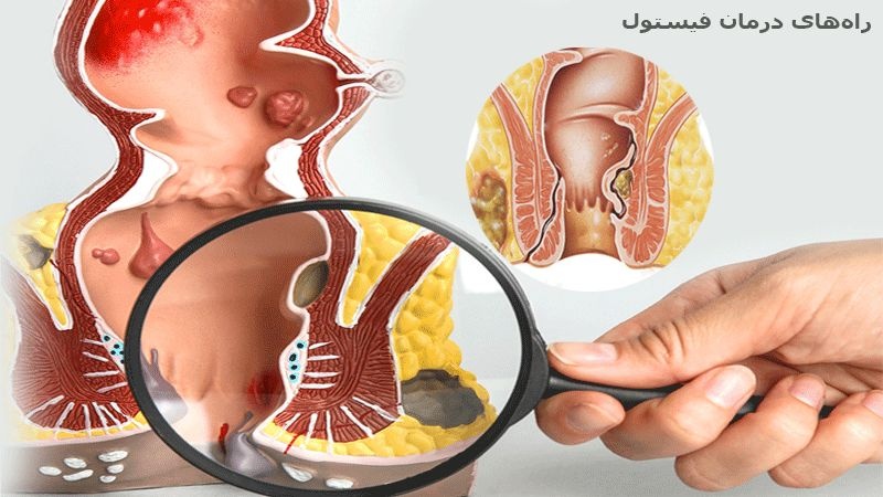 لیزر فیستول مقعد بهترین روش سرپایی درمان فیستول (2 نکته مهم) لیزر فیستول مقعد بهترین روش سرپایی درمان فیستول (2 نکته مهم)
