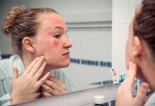 حساسیت به تخم مرغ چه علائمی دارد؟ (2 نکته مهم)