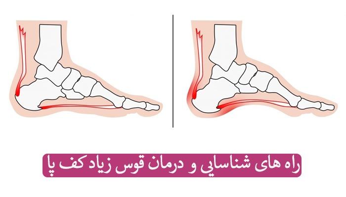 گودی و قوس زیاد کف پا