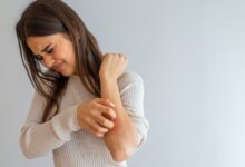 حساسیت پوستی کهیر و شیوه های درمانی جدید آن (2 نکته مهم)