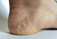 علت برجستگی های سفید روی پاشنه پا ( پاپول پیزوژنیک ) چیست ؟ (2 نکته مهم)