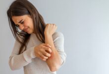 فرق بین بیماری کهیر حاد و مزمن چیست؟ (2 نکته مهم)