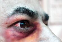 علائم قارچ سیاه (موکورمایکوزیس) : بیماری که باعث نابینایی و مرگ می شود (2 نکته مهم)