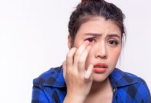 دلیل ایجاد عارضه کموسیس چشمی چیست ؟ (2 نکته مهم)