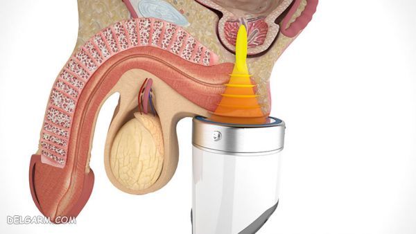 التهاب پروستات چیست ؟ آیا التهاب پروستات درمان میشود ؟ (2 نکته مهم) عوارض التهاب پروستات