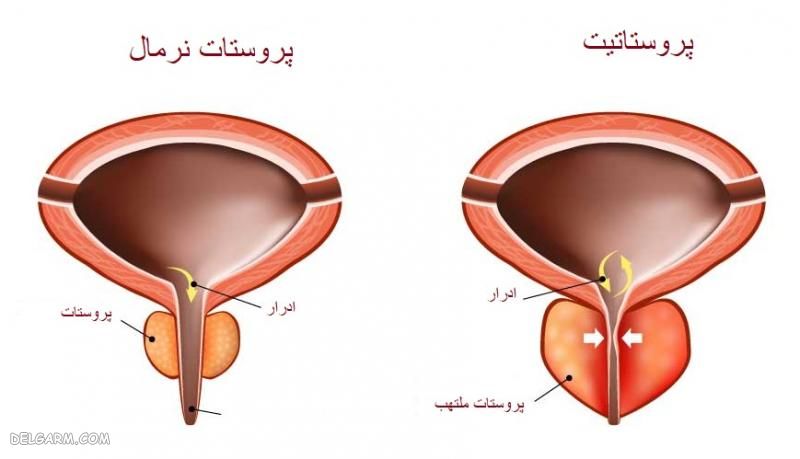 علت التهاب پروستات