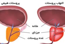 التهاب پروستات چیست ؟ آیا التهاب پروستات درمان میشود ؟ (2 نکته مهم)