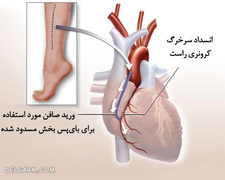 عمل جراحی بای پس قلب