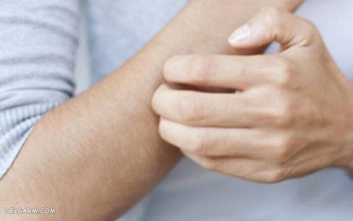 یکی دیگر از علائم کرونا ، پیدایش کهیر 