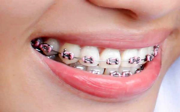 علت درد ارتودنسی چیست ؟ + سوالات متداول درد ارتودنسی (2 نکته مهم) علت درد ارتودنسی چیست ؟ + سوالات متداول درد ارتودنسی (2 نکته مهم)