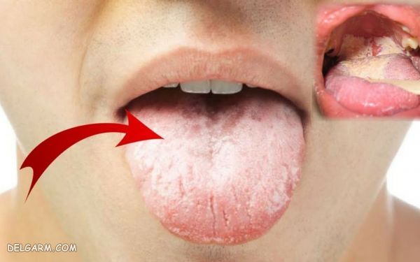 بیماری لثه یا ژنژیویت 