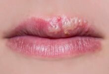 سرطان لب چگونه ایجاد میشود ؟ (2 نکته مهم)