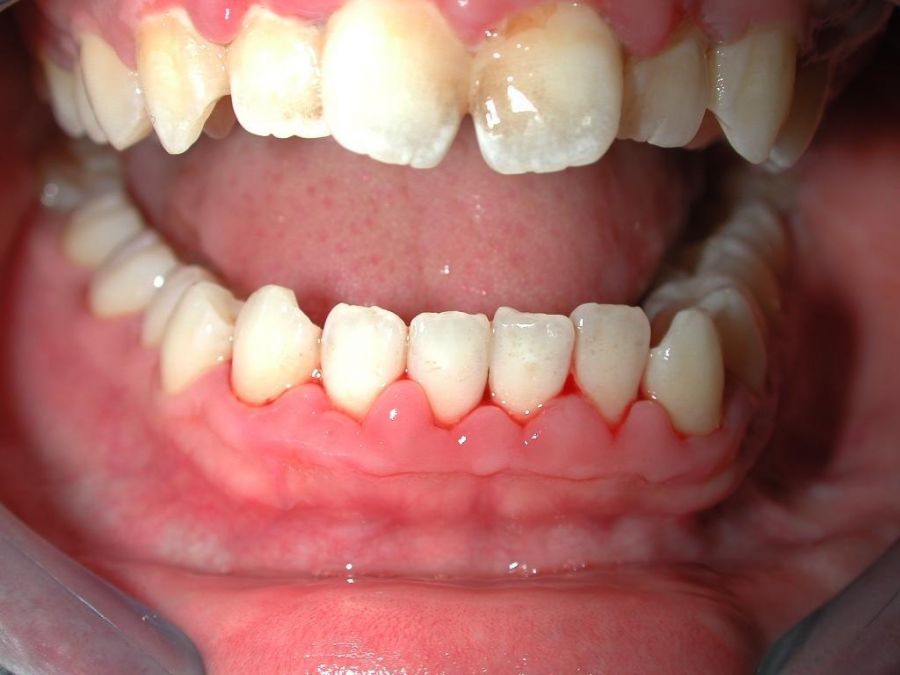 نشانه های بیماری اسکوربوت کدام است؟ (2 نکته مهم) نشانه های بیماری اسکوربوت کدام است؟ (2 نکته مهم)