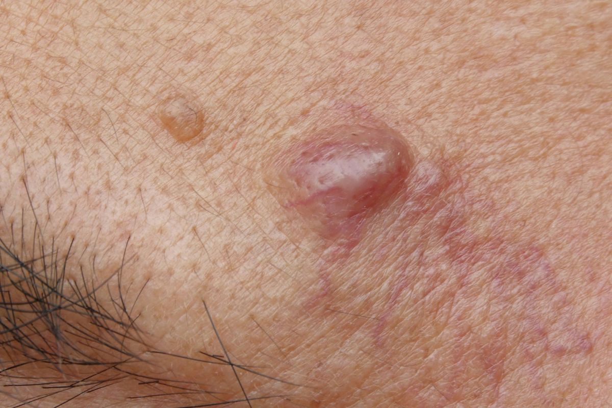 علت کیست پوستی صورت چیست؟ (2 نکته مهم)
