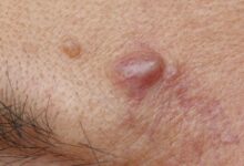 علت کیست پوستی صورت چیست؟ (2 نکته مهم)