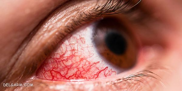 علائم حساسیت و آلرژی چشم