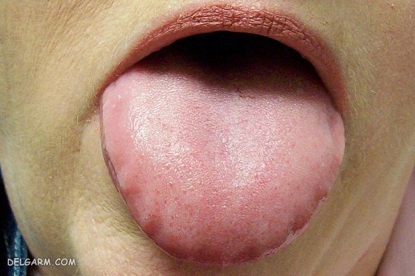 زبان دالبری / زبان اسکالوپ