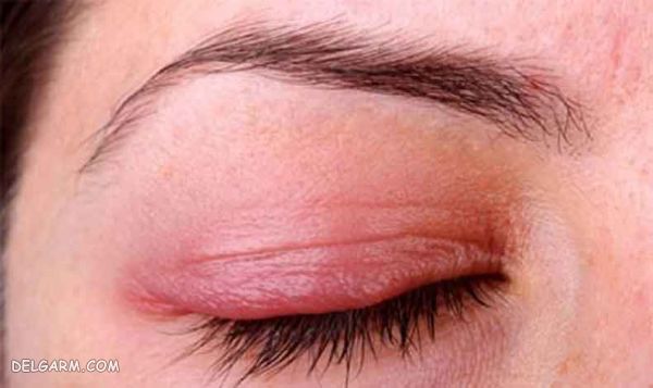 حساسیت چشم / اگزمای چشم / خارش چشم