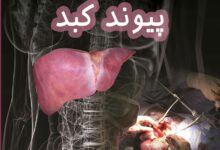 عوارض پیوند کبد چیست ؟ آشنایی با شرایط جراحی پیوند کبد (2 نکته مهم)