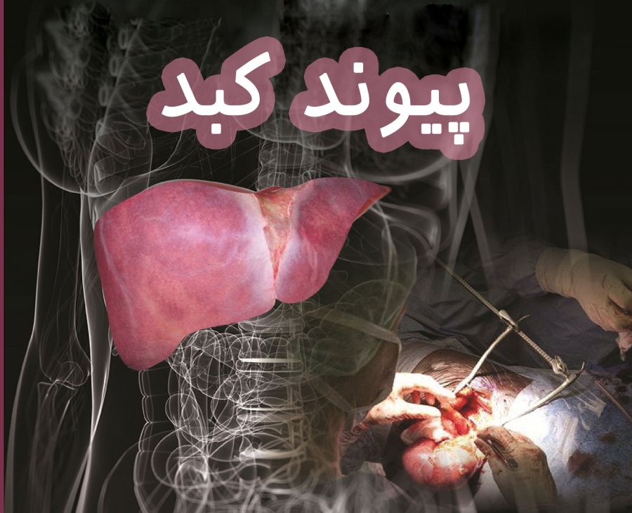 عوارض پیوند کبد چیست ؟ آشنایی با شرایط جراحی پیوند کبد (2 نکته مهم) عوارض پیوند کبد چیست ؟ آشنایی با شرایط جراحی پیوند کبد (2 نکته مهم)