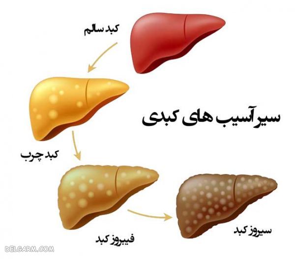 مسیر تبدیل کبد چرب به سیروز کبدی 