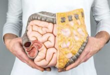 زخم دوازدهه چیست (Duodenal ulcer) چیست و چگونه درمان میشود ؟ (2 نکته مهم)