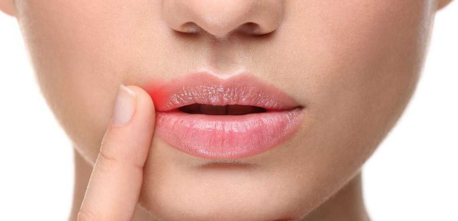 علت ایجاد آفت دهان چیست ؟ چه عواملی باعث بروز آفت دهان می‌شوند ؟ (2 نکته مهم)