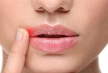 علت ایجاد آفت دهان چیست ؟ چه عواملی باعث بروز آفت دهان می‌شوند ؟ (2 نکته مهم)