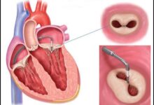 علائم پرولاپس دریچه میترال چیست و چگونه درمان میشود ؟ (2 نکته مهم)