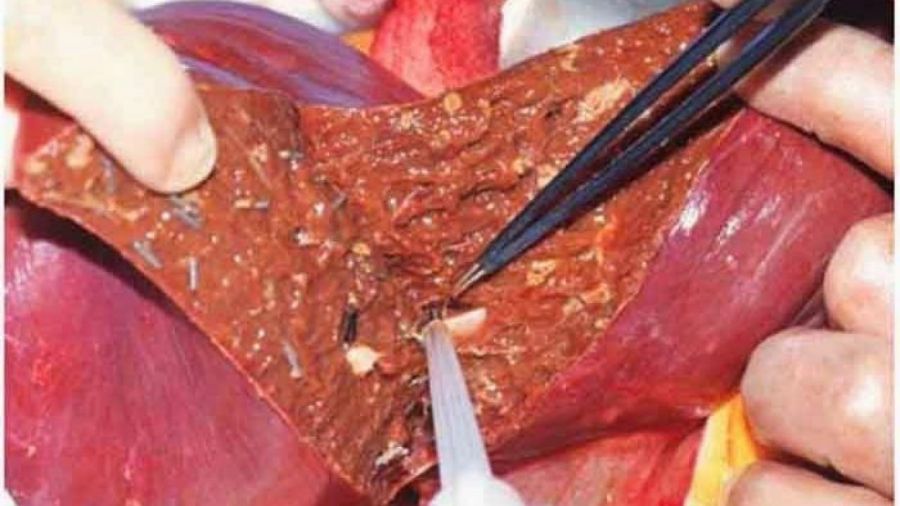 متاستاز کبد چیست و چگونه قابل تشخیص است ؟ (2 نکته مهم) متاستاز کبد چیست و چگونه قابل تشخیص است ؟ (2 نکته مهم)